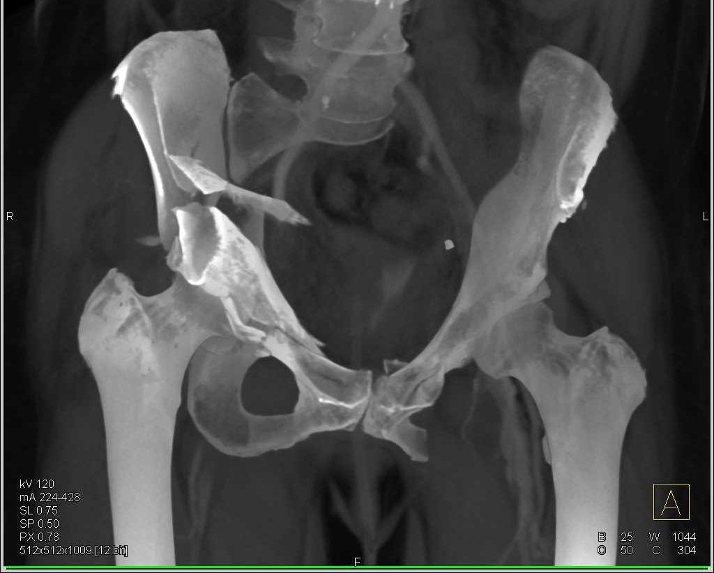 Перелом седалищной кости таза рентген