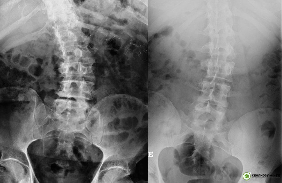 Рентген крестцового отдела. Сколиоз пояснично-крестцового отдела. Левосторонний сколиоз рентген. Сколиоз поясничного отдела 2 степени рентген. Левосторонний сколиоз 1 степени рентген.