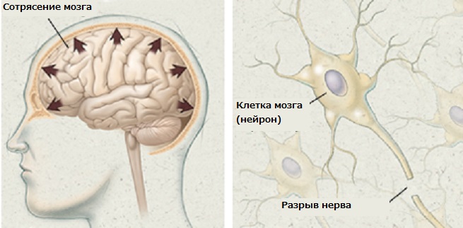 3 сотрясения мозга. Снимок головного мозга при сотрясении.
