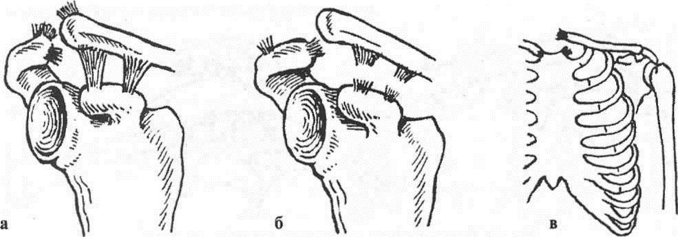 Вывих ключицы. Неполный вывих акромиального конца ключицы. Неполный вывих акромиального конца ключицы происходит. Вывих акромиального конца ключицы типы. Фиксация вывиха акромиального конца ключицы.