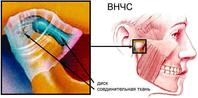 Контрактура жевательных